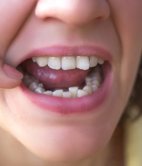Photo of crooked woman teeth