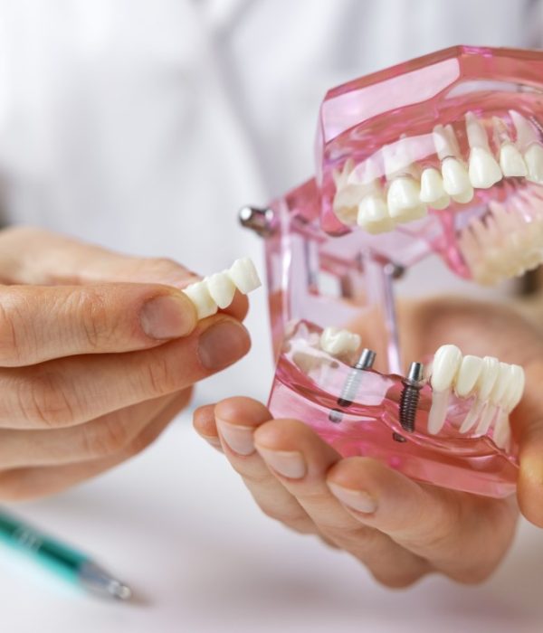 dentist implantologist showing dental bridge implant technology on human tooth jaw model