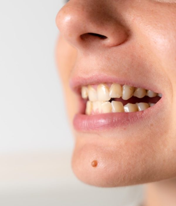 Crooked and yellow teeth. Woman has malocclusion. Adult orthodontics problem and treatment. Somatology medicine. High quality photo